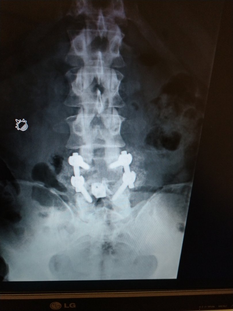 Spine x ray.jpg